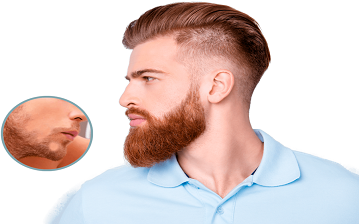 Facial hair transplant